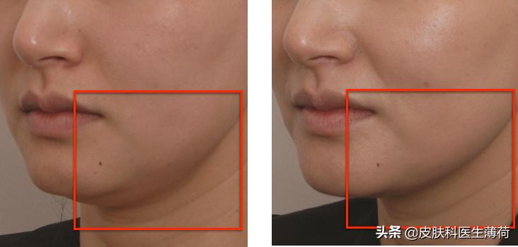 皮秒激光祛雀斑效果图,激光祛痘坑效果