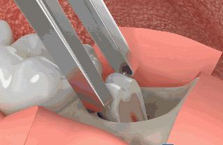 拔智齿真实过程无切口,拔智齿真实体验