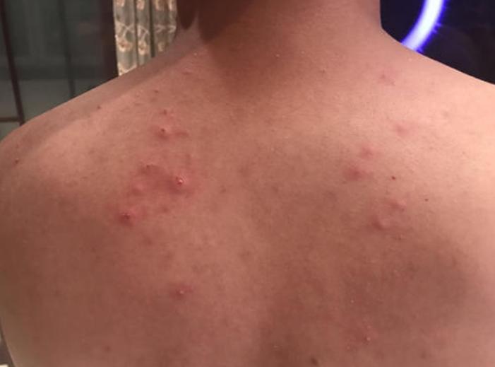 背部爆痘用什么药,背部长痘原因以及怎么调理
