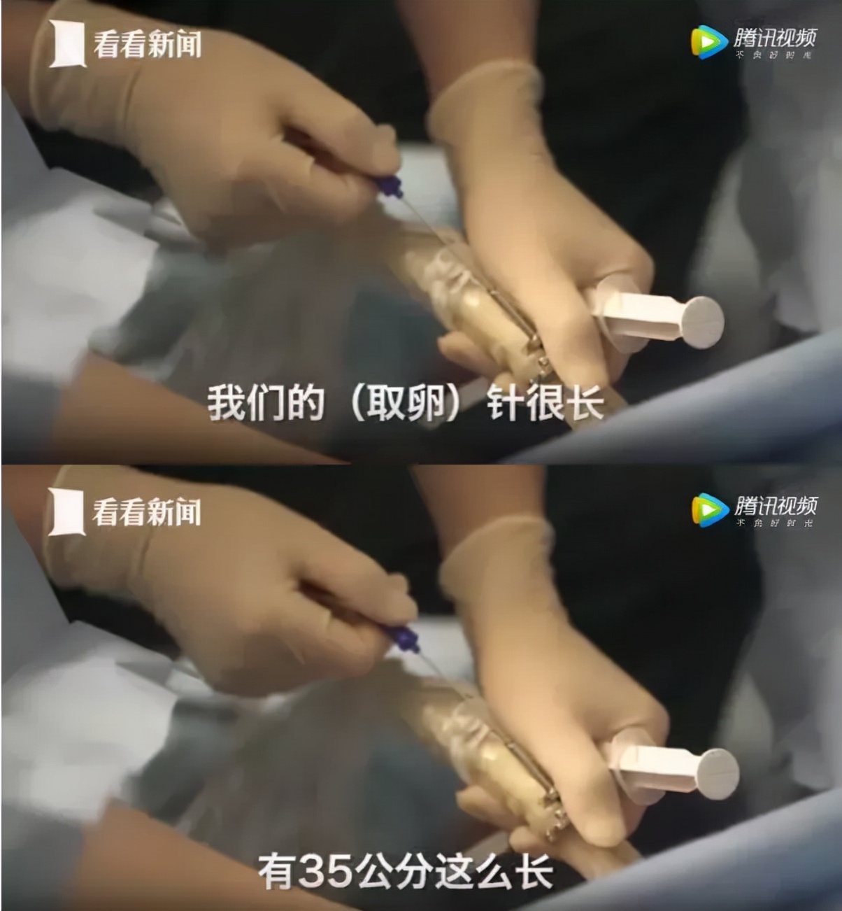 捐卵一次3万、安全无害？她说：我这辈子再也当不了妈妈了