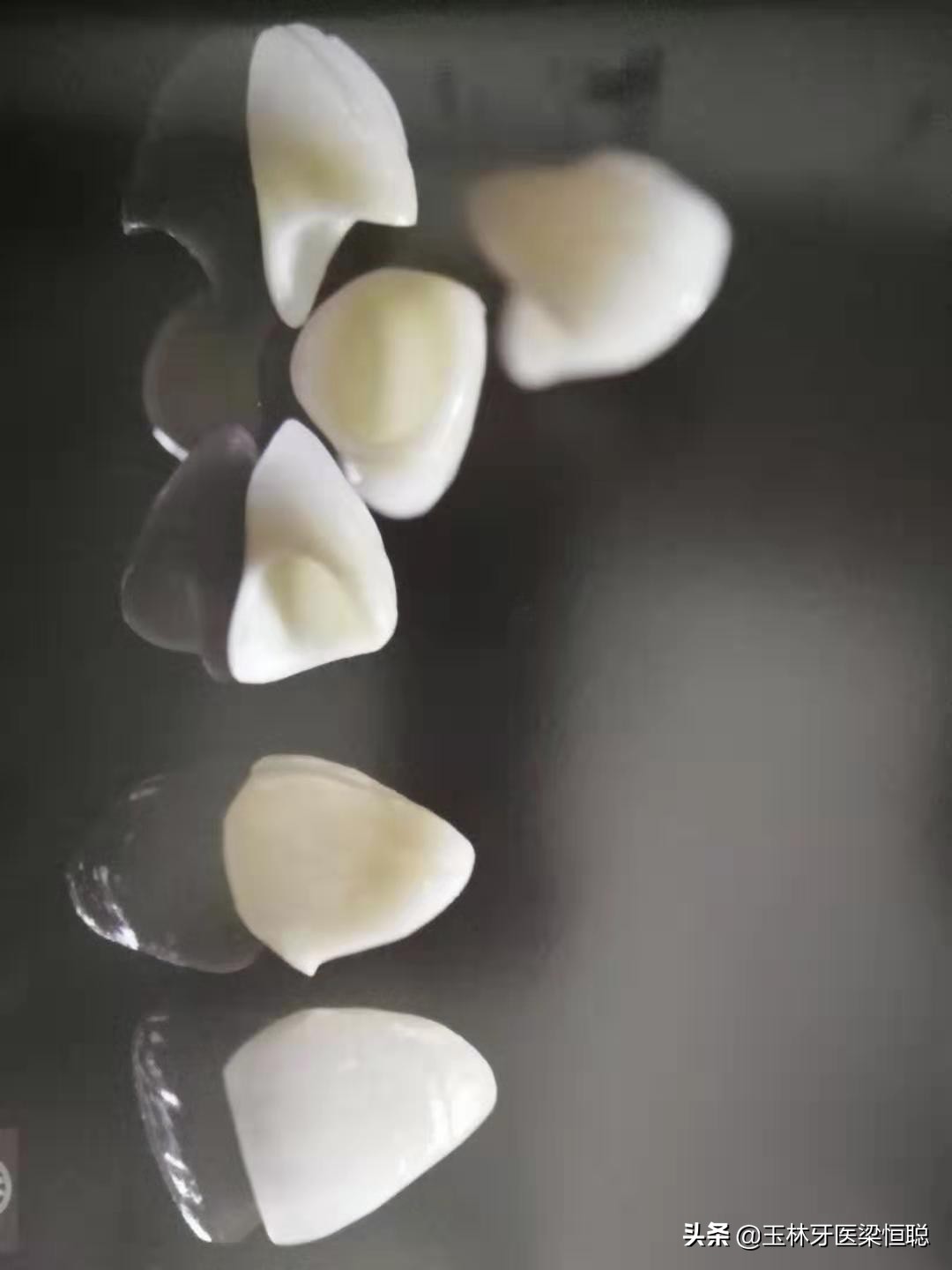 全瓷牙和烤瓷牙冠的区别,烤瓷牙和全瓷牙冠有什么区别