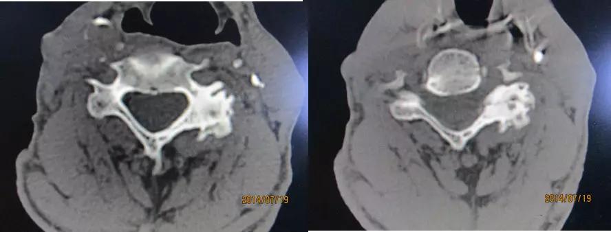 颈椎腰椎疾病ct及mri诊断,腰椎ct可以发现肠部病变吗
