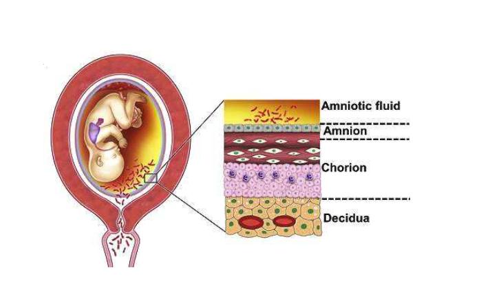 准妈妈破水发热，宝宝胎心快要当心绒毛膜羊膜炎