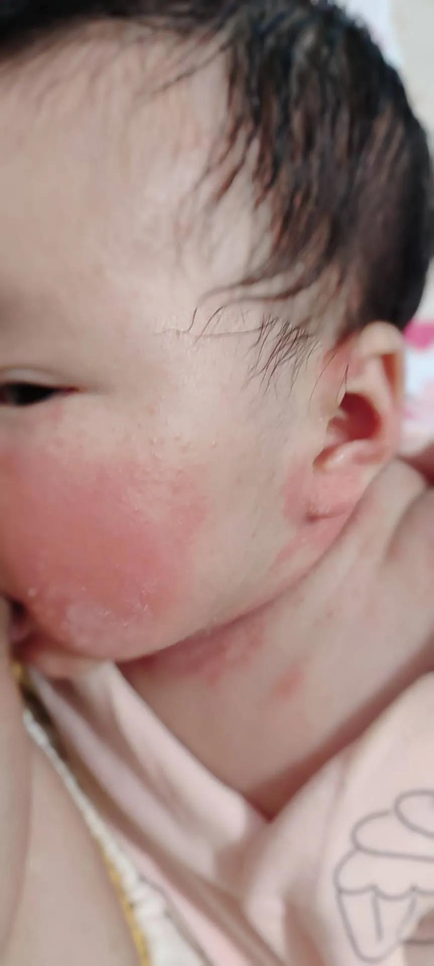 根治湿疹特效药,宝宝湿疹大作战图文