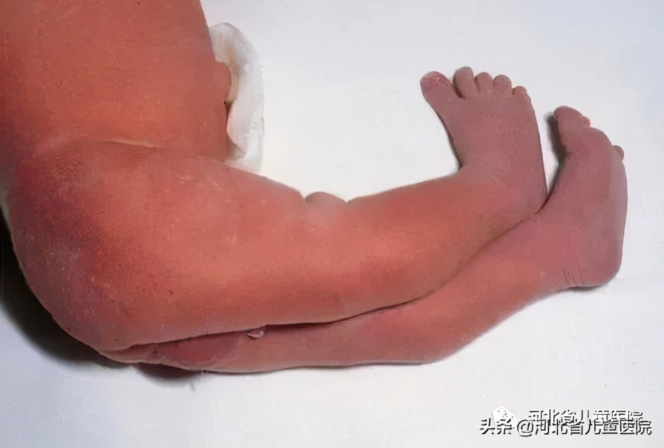 腿纹不对称家长千万别忽视,腿纹深浅不一样算不对称吗