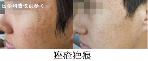 *疮痤**疤痕可以用什么方法淡化