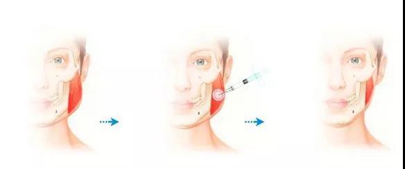 瘦脸针打了可以瘦脸上哪些地方,瘦脸针能打么