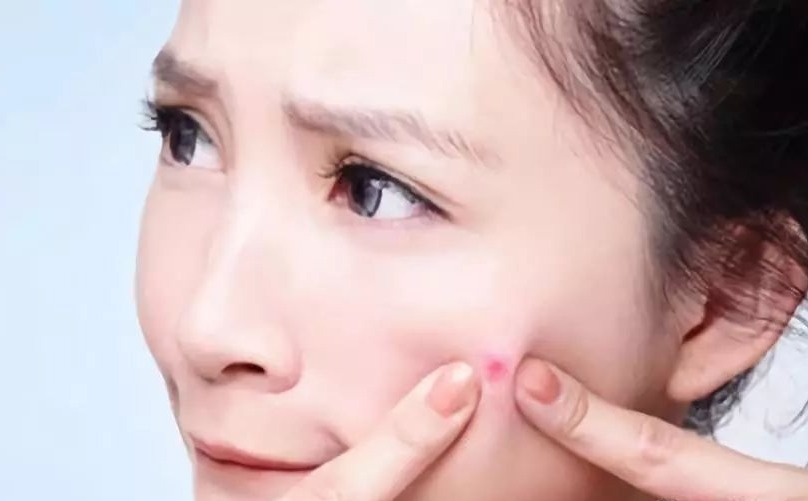 祛痘印最好的6个方法,祛痘印得最快的药膏