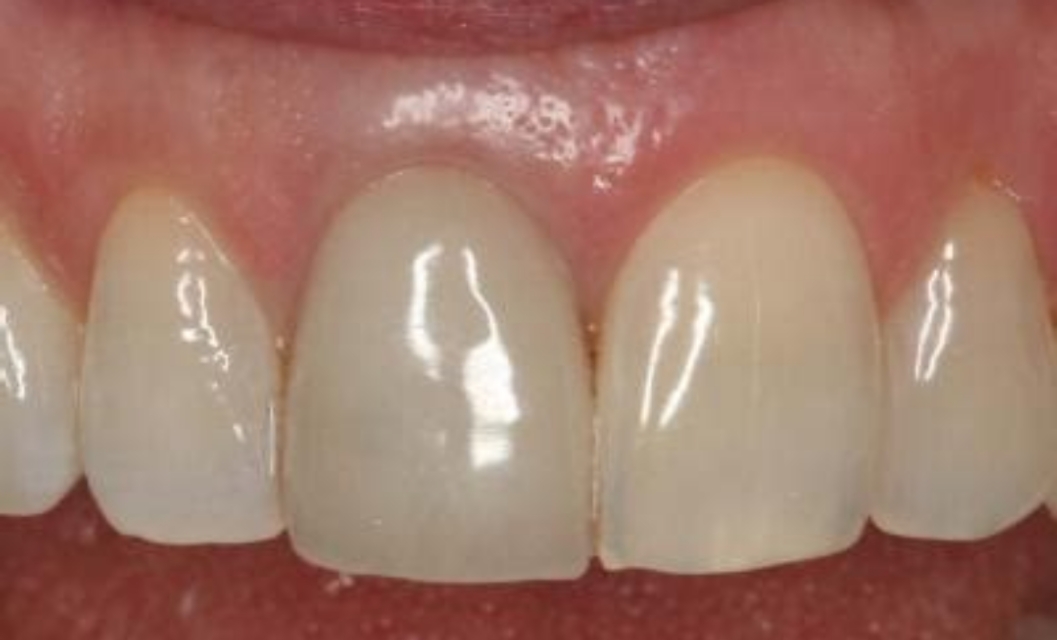 爱美者的100个困惑,牙齿缺失不想种植怎么办