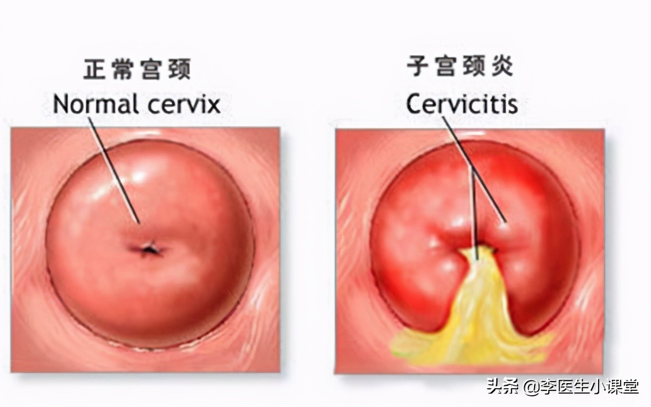怎么预防淋病传染给家人,高锰酸钾可以预防淋病么