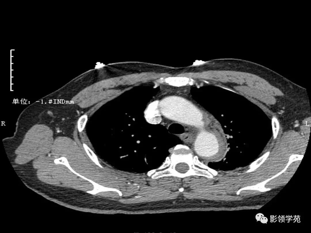 主动脉壁间血肿护理查房,主动脉夹层和壁间血肿图片