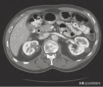 多发肾囊肿和多囊肾有什么区别,多囊肾跟多发肾囊肿有什么区别