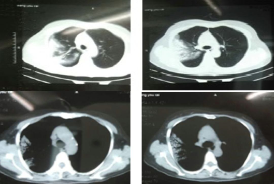 抗感染治疗后效果欠佳，感染非感染？TBLB和肺穿刺病理有哪些提示