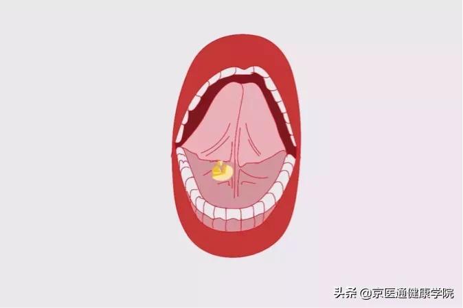 速效救心丸救不救高血压,速效救心丸救老梗吗