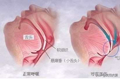 老人在家里突发脑出血怎么救命,家人脑出血了安全了怎么安慰