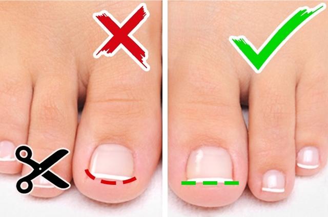 脚趾甲长进肉里的处理方法,甲沟炎导致指甲甲肉分离能恢复吗