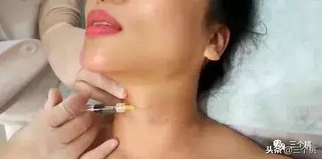 医美去颈纹全过程,去颈纹医美过程