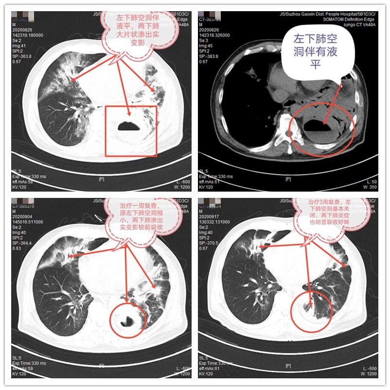 高烧肺脓肿严重吗,高热咳嗽咳痰全身疼