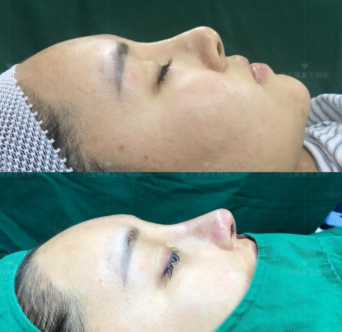 线雕隆鼻后鼻综合修复术,隆鼻失败修复手术真实案例