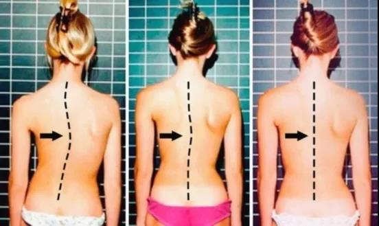 孩子发现脊柱侧弯该怎么办,十七岁女孩发现脊柱侧弯怎么办