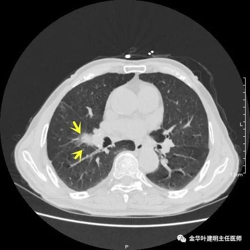 多发原发肺癌能根治吗,肺部原发性恶性肿瘤好治