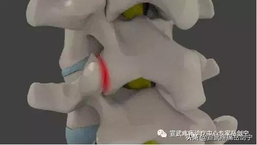 腰突然弯曲感觉卡住,腰突然像卡住的不能动怎么缓解