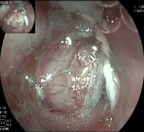贲门处见隆起性病变,贲门高级别瘤变esd术后不能吃什么