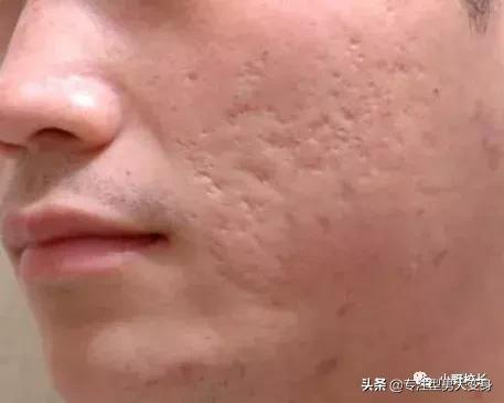 祛痘印有效的精华,祛痘印最有效的方法有4招