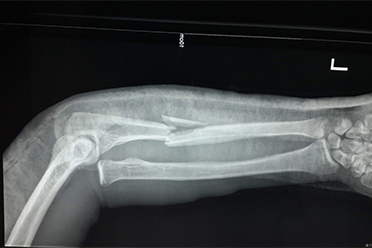 孩子骨折手法复位,孩子骨折了该如何自救