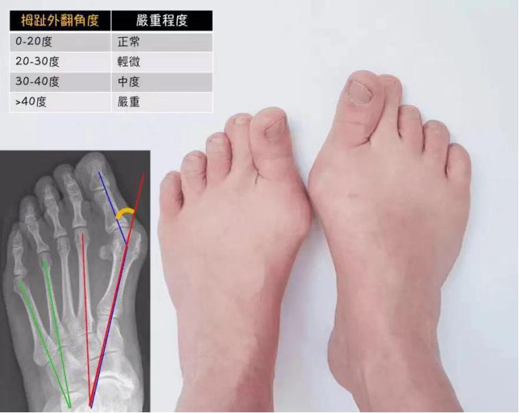 拇指外翻畸形的治疗方法,小孩脚拇趾外翻矫正方法