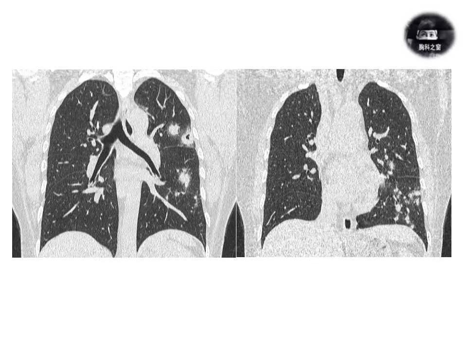 双肺多发结节是肺癌的征兆吗,双肺多发结节灶