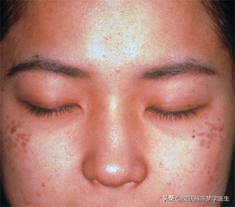 色斑的种类及治疗,色斑属于常见的什么皮肤问题