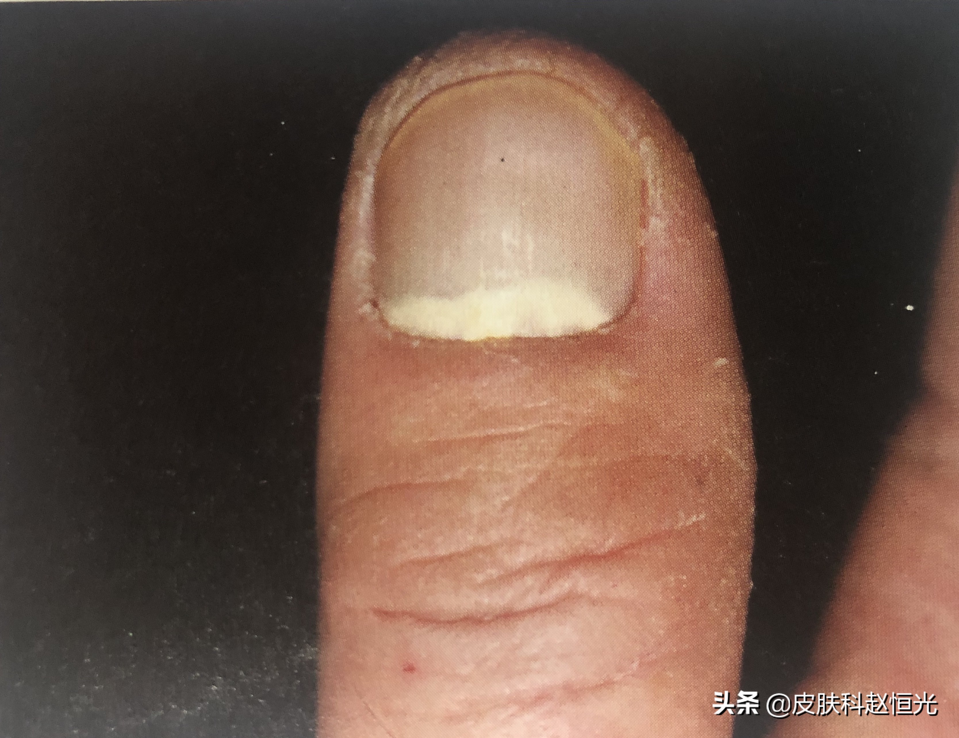 怎么预防脚上的灰指甲传染手上,灰指甲传染率高及时处理避免扩散