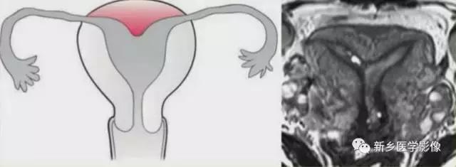 常见的几种子宫畸形诊断标准,先天性子宫畸形是什么原因造成的