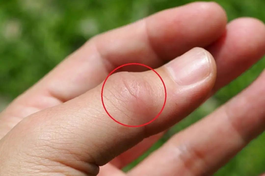 老公隐瞒自己得了「痛风」，老婆打算起诉离婚，你怎么看？