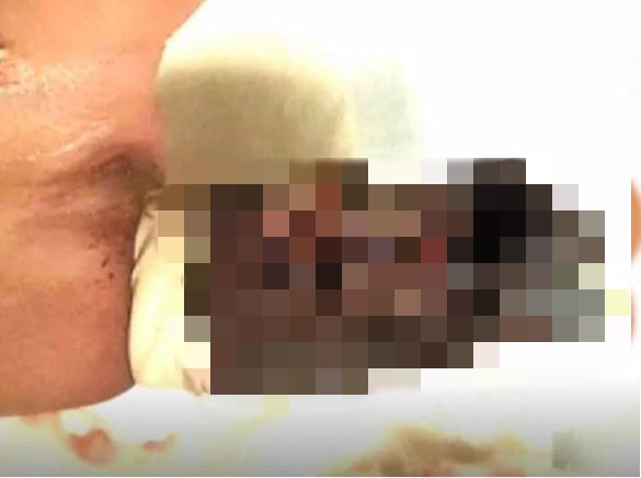 医生忘取止血带，澳洲女运动员被迫截断拇指用脚趾代替，生涯尽毁