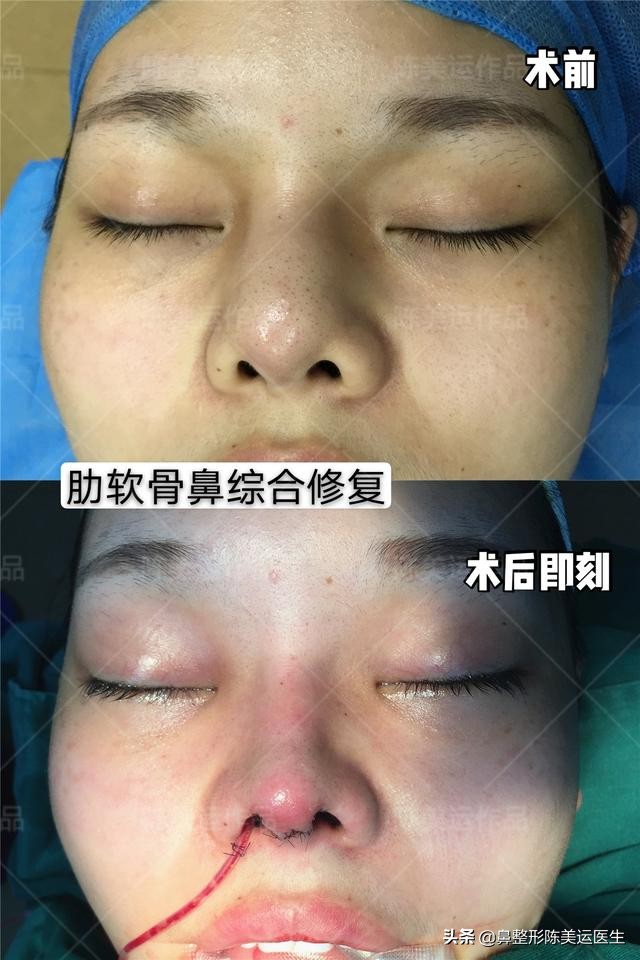 为什么医生都反对线雕隆鼻,到底要不要做线雕隆鼻