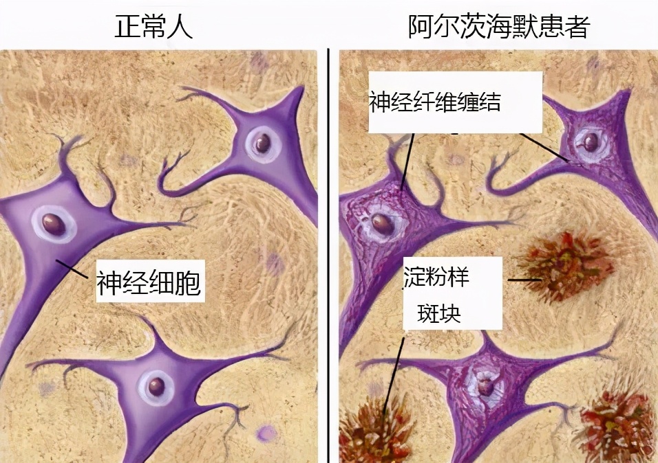 高血压心脏病有什么症状表现,肾性高血压的症状表现有哪些