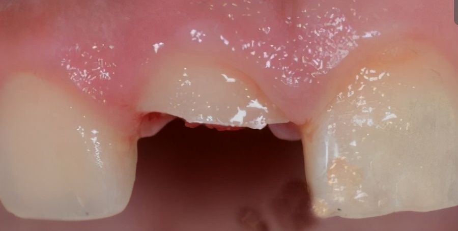 30多岁牙齿缺失能不能拔牙,30岁缺失多颗牙齿