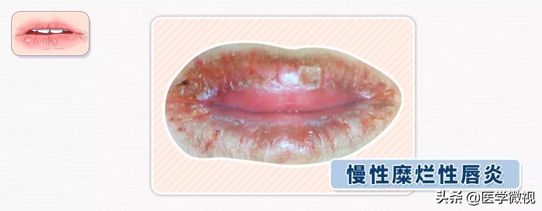 嘴唇干裂起皮反反复复,嘴唇一年四季干燥起皮是什么原因