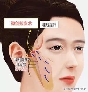 剥离拉皮提拉紧致,拉皮提拉紧致抗皱手术