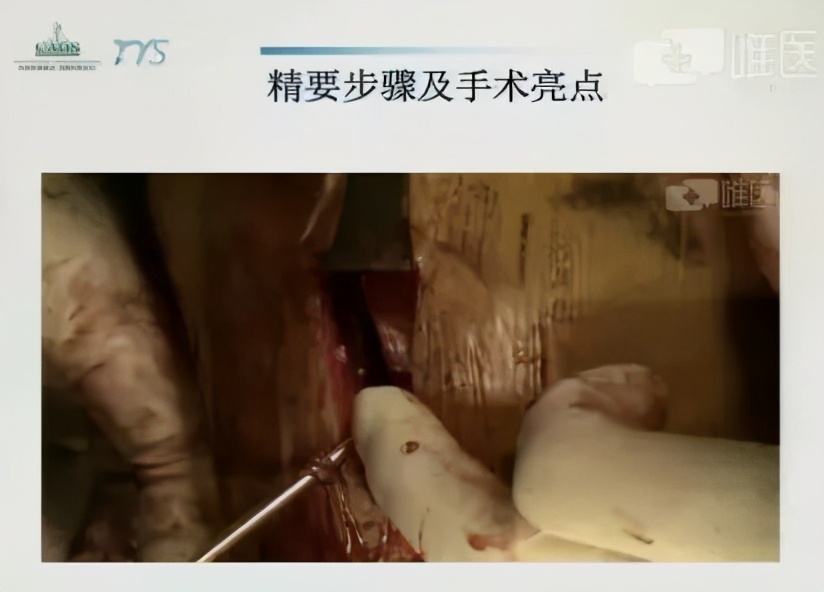 单纯的腓骨轻微骨折怎么治疗,70岁的人胫腓骨骨折了怎么治疗好