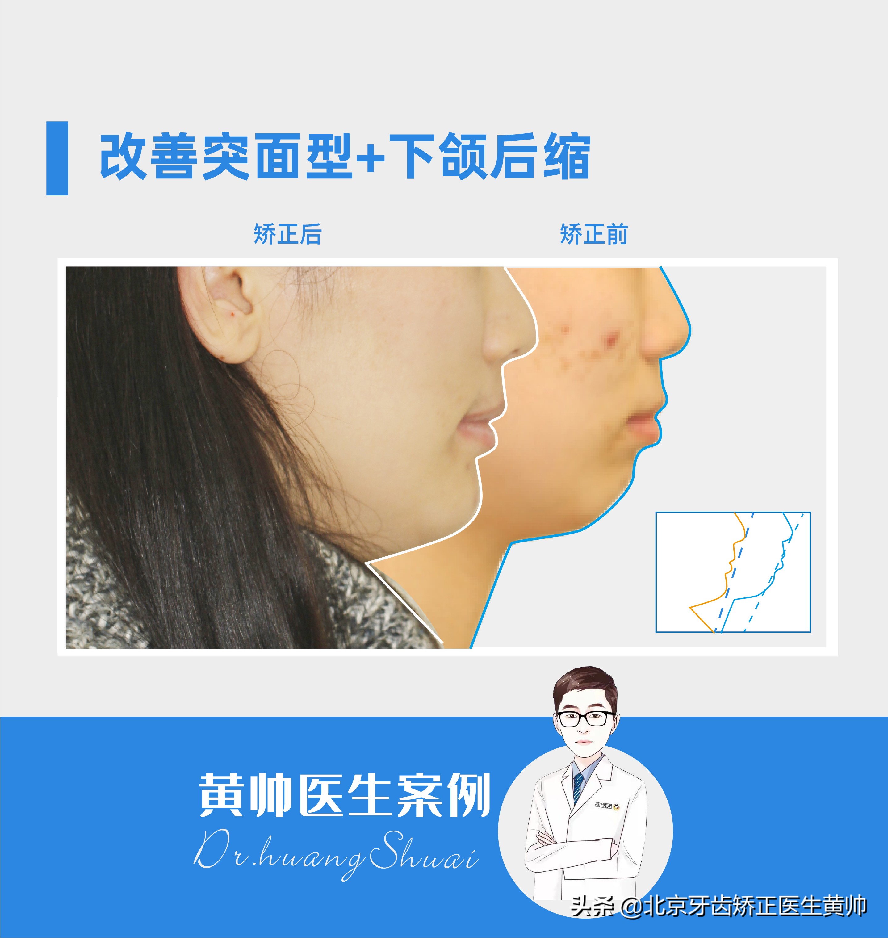 橡胶牙套矫正后脸型变化,戴过牙套的脸恢复了吗