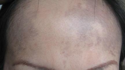 最近好像有点长斑了怎么可以改善,30岁开始长斑怎样来预防