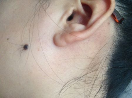 色素痣怎样去除,色素痣怎么去除最快最有效