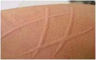 儿童荨麻疹过敏炎症会不会传染,宝宝麻疹受风怎么办