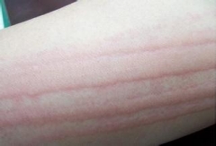 人工性荨麻疹是怎么引起的,人工性荨麻疹都有什么症状