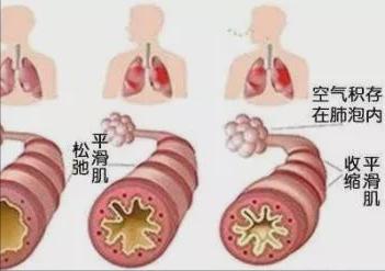 中医治疗哮喘有哪些优势,哮喘中医真的治得好吗