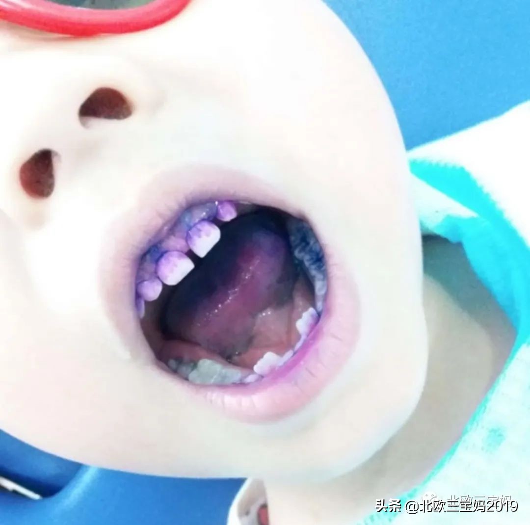 5岁小孩打全麻治蛀牙有影响吗,3岁孩子全麻风险大吗