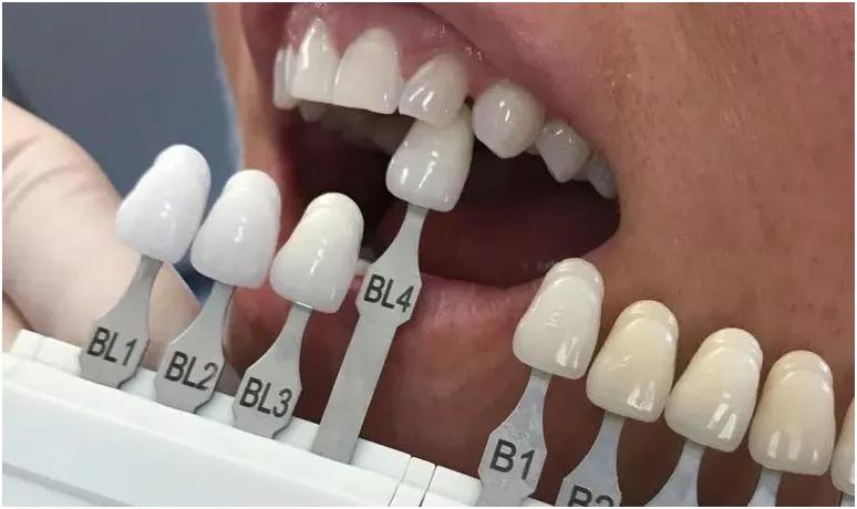 瓷贴面微笑的力量,局部瓷贴面